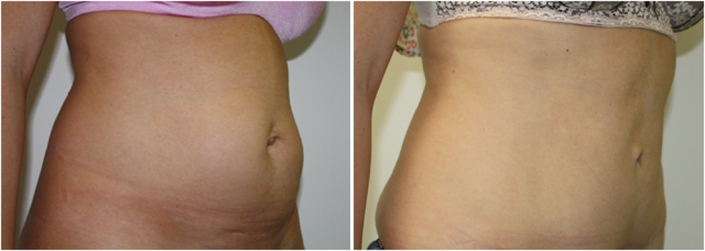 37yo female, 2 children, significant bulge from widely separated muscles eliminated with a tummy tuck procedure.