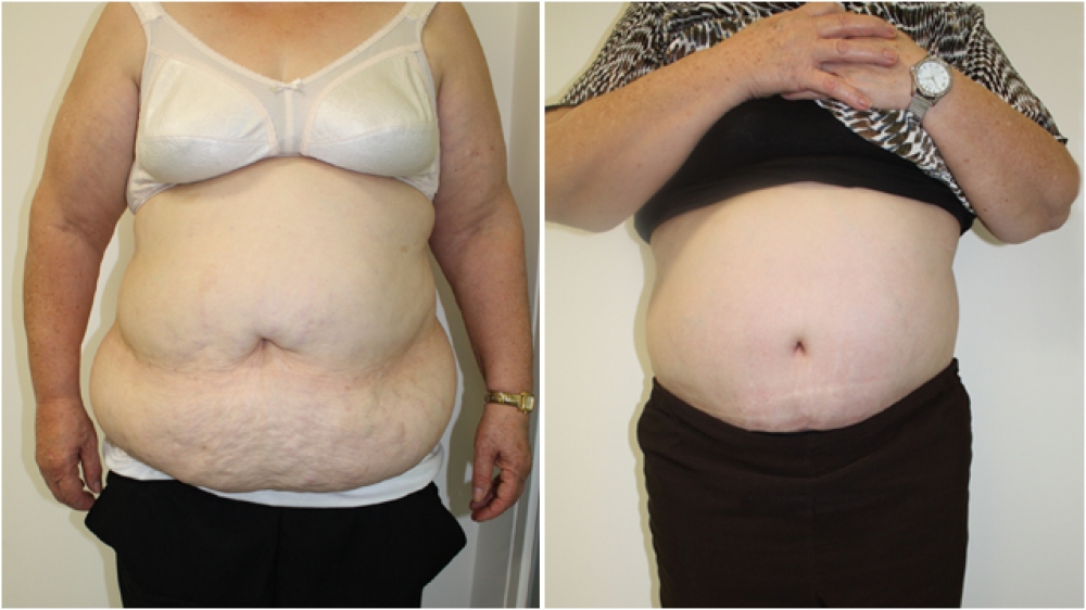 63yo female, requiring major contour restoration, belly button reshaping, as well as large amount of redundant skin and fat removal. An extended tummy tuck operation was performed to achieve these goals.