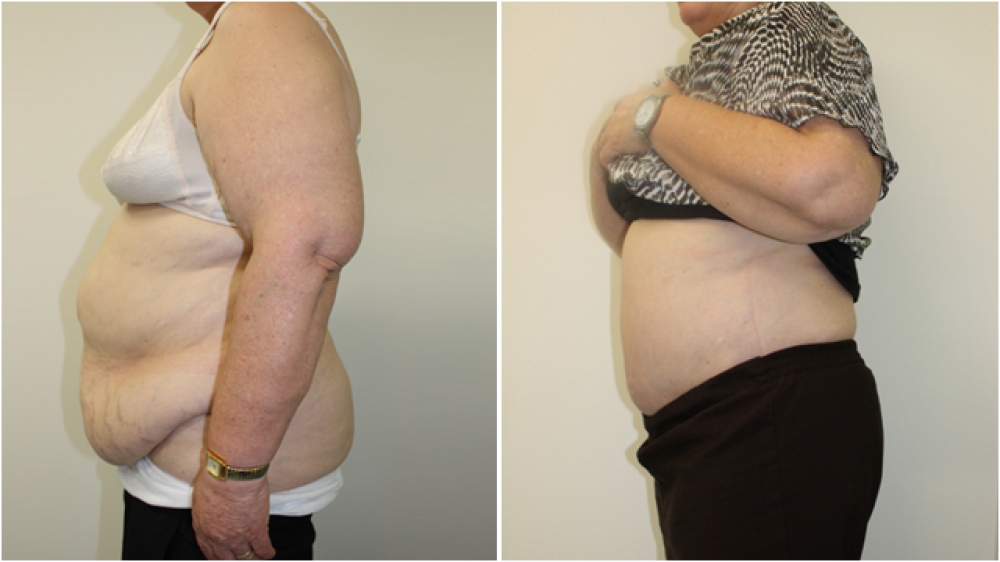 63yo female, requiring major contour restoration, belly button reshaping, as well as large amount of redundant skin and fat removal. An extended tummy tuck operation was performed to achieve these goals.