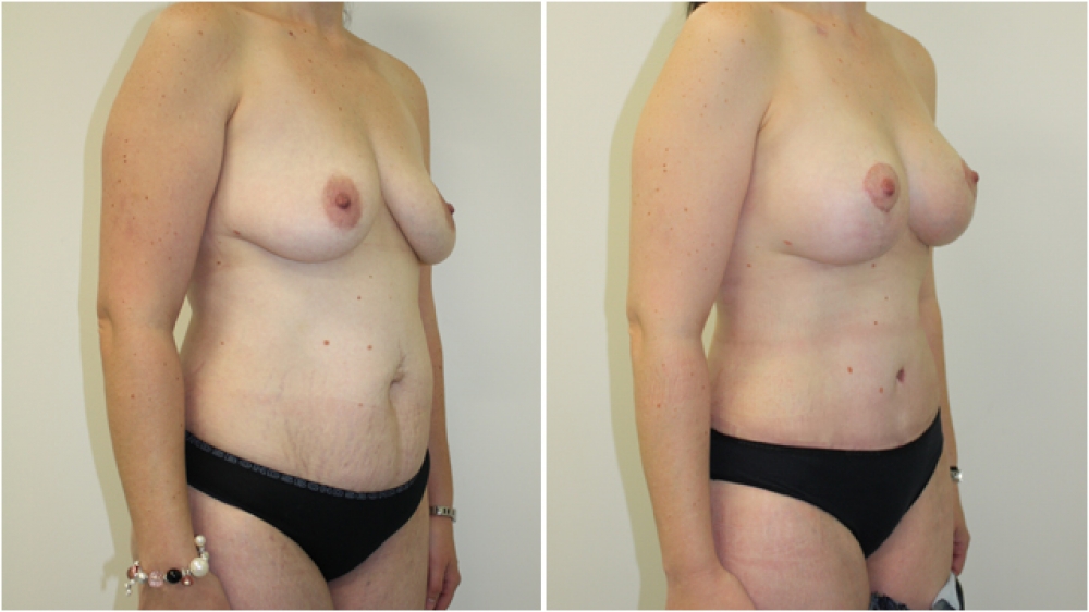 31 yo, 3 children, full tummy tuck performed to remove excess skin, stretch marks as well as tighten the abdominal musculature and reshape the belly button.