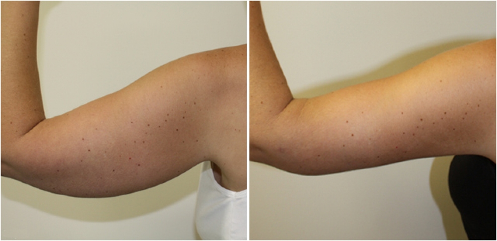 40 year old woman, post weight loss, underwent brachioplasty procedure to give the arms a more slim and youthful appearance.