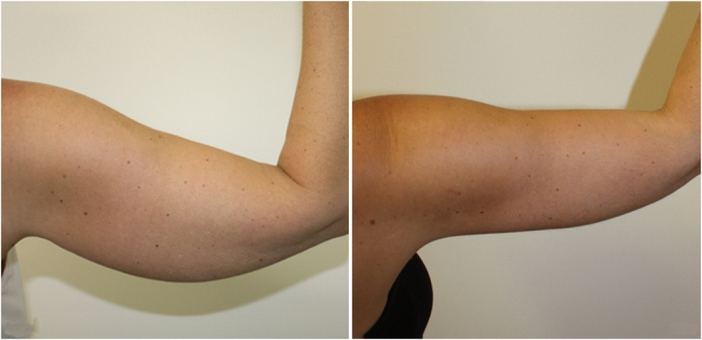 40 year old woman, post weight loss, underwent brachioplasty procedure to give the arms a more slim and youthful appearance.
