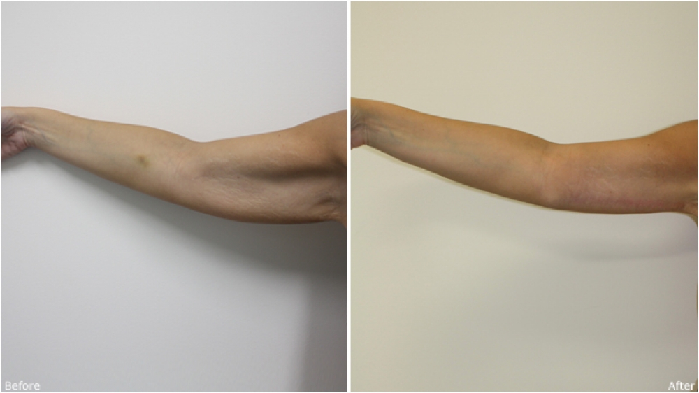 33 yo female, weight loss, concerned with 'bat wing' like appearance of her upper arms. Underwent surgical brachioplasty (arm lift) and liposuction to correct the problem.