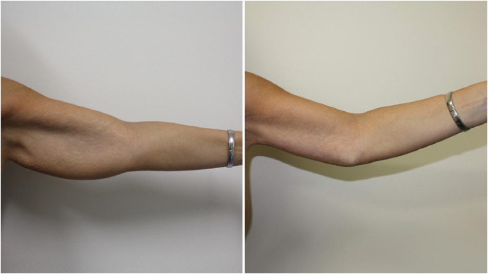 33 yo female, weight loss, concerned with 'bat wing' like appearance of her upper arms. Underwent surgical brachioplasty (arm lift) and liposuction to correct the problem.