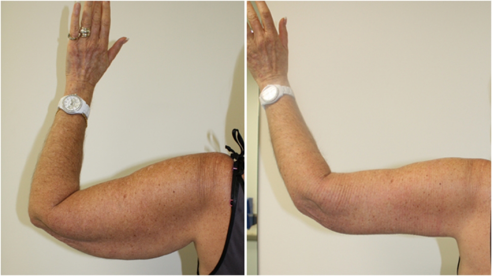 59 year old woman, requesting reduction of excess skin off both upper arms. Additional liposuction was used to remove the excess fat.