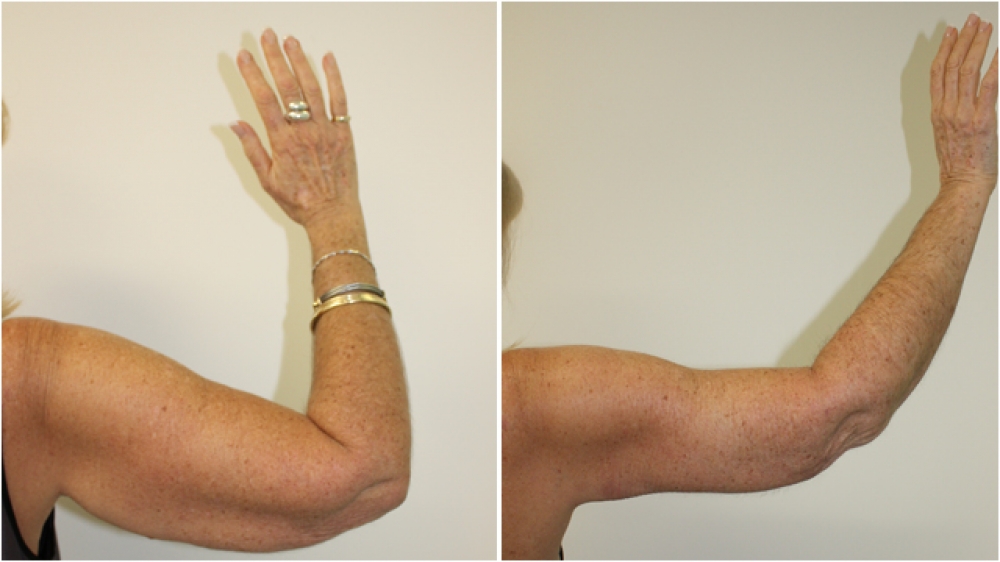 59 year old woman, requesting reduction of excess skin off both upper arms. Additional liposuction was used to remove the excess fat.