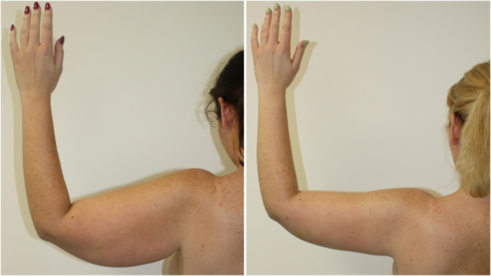 25 year old woman, post weight loss, underwent brachioplasty procedure to achieve a more streamline appearance.