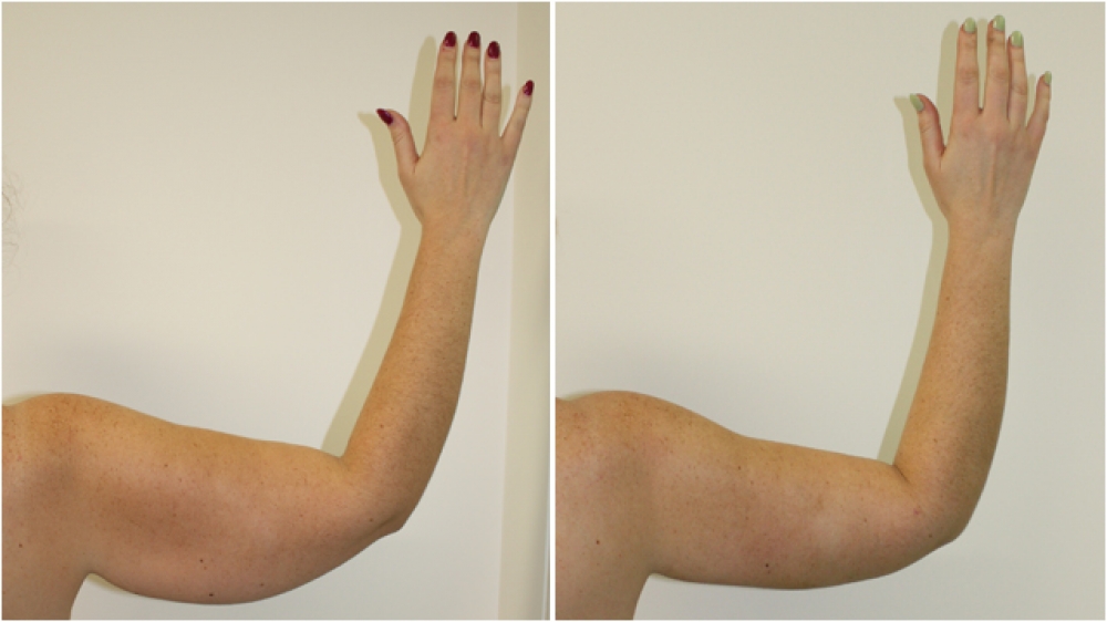 25 year old woman, post weight loss, underwent brachioplasty procedure to achieve a more streamline appearance.