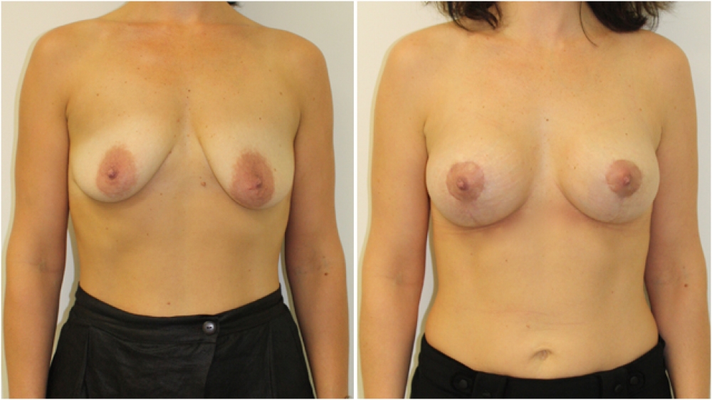 Late 30s, 2 children, vertical short- incision breast lift combined with 280g moderate projection anatomical implants.