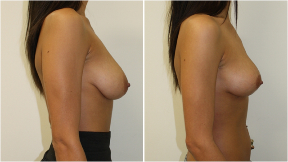 Late 20s, no children, vertical short-incision breast lift (mastopexy) and nipple/areolar reduction/repositioning.