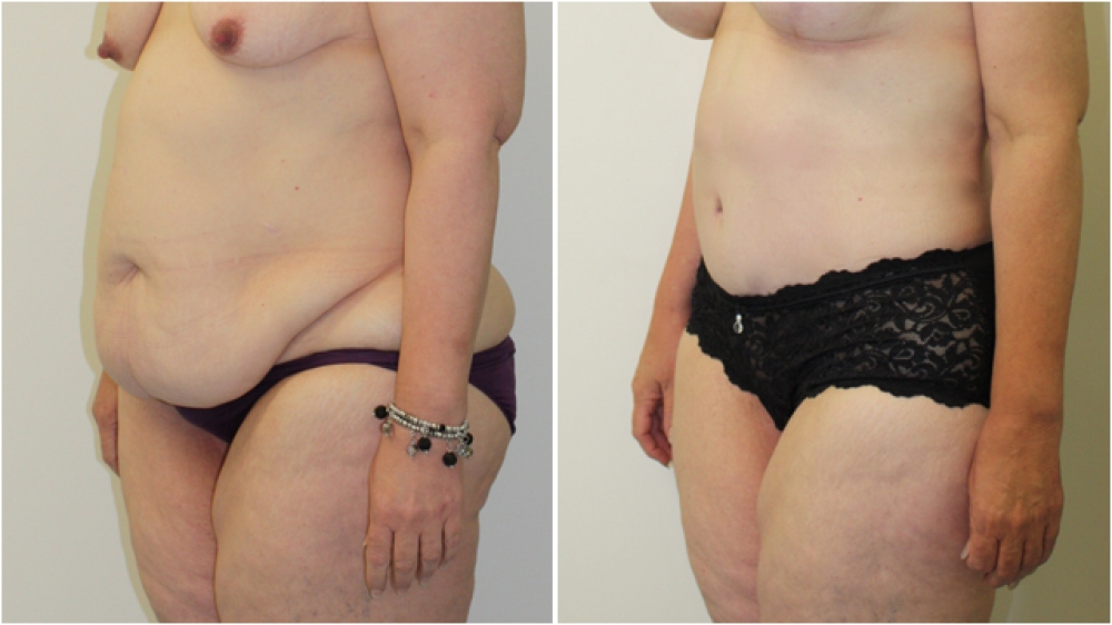 Early 50s, two children and large weight loss.