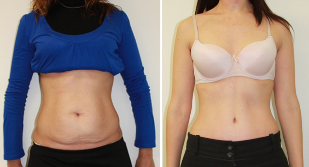 Mid 30s, 3 children, full tummy tuck procedure performed by Dr Miroshnik to remove excess fat and skin, while providing better abdominal definition.