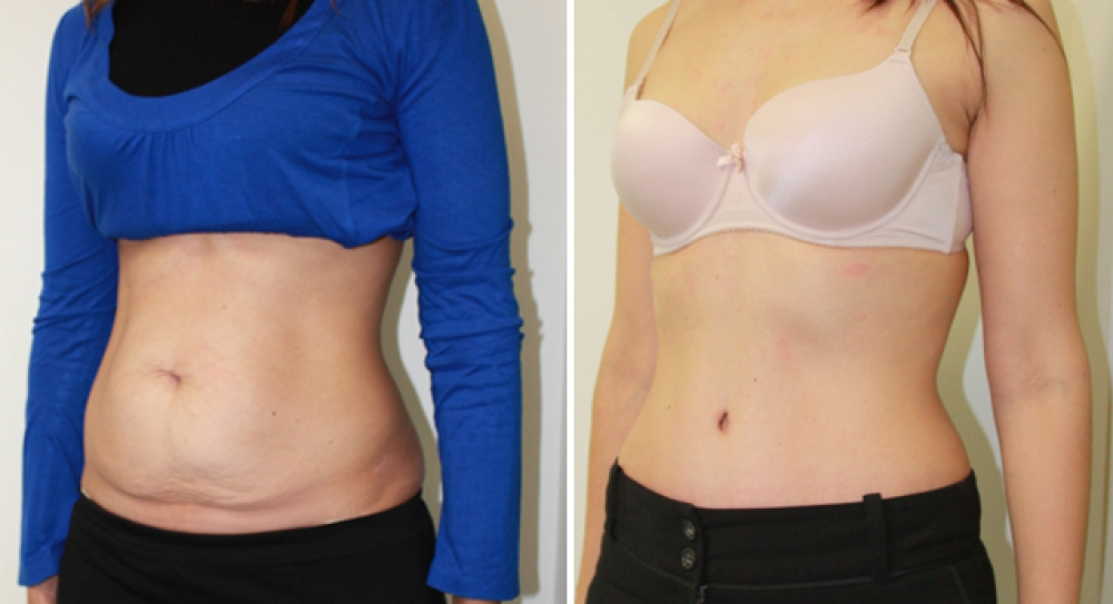 Mid 30s, 3 children, full tummy tuck procedure performed by Dr Miroshnik to remove excess fat and skin, while providing better abdominal definition.