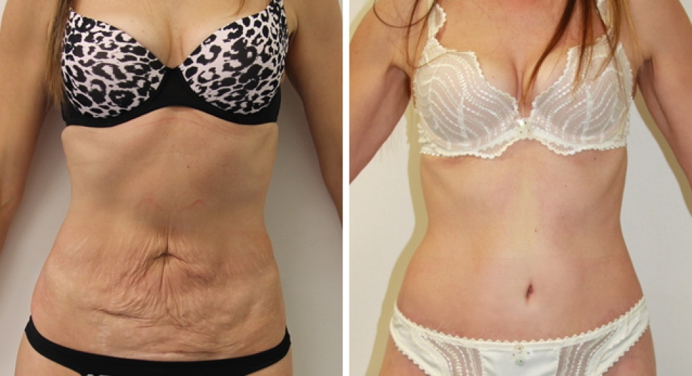 50 yo, 3 children, full tummy tuck procedure performed by Dr Miroshnik to remove excess fat and skin.