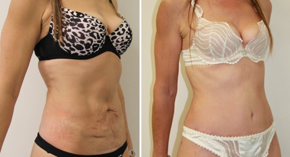 50 yo, 3 children, full tummy tuck procedure performed by Dr Miroshnik to remove excess fat and skin.