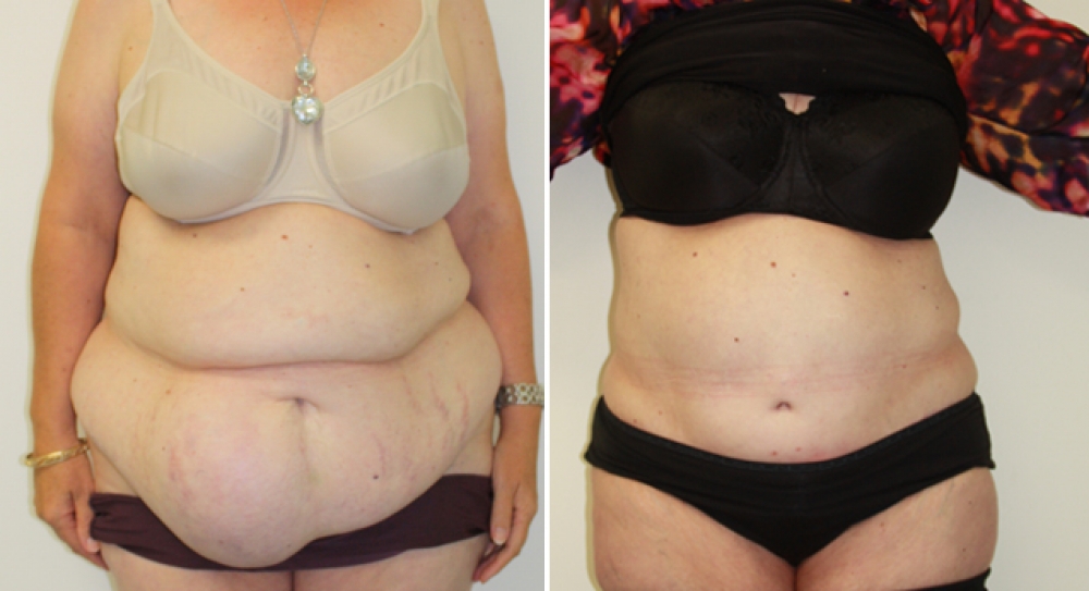 Mid 40's, 4 children, recent 40kg weight loss. Large hernia repair plus full extended abdominoplasty procedure performed to remove excess skin, fat and stretch marks, to create significant improvement in contour and definition of waistline.