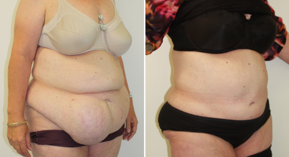 Mid 40's, 4 children, recent 40kg weight loss. Large hernia repair plus full extended abdominoplasty procedure performed to remove excess skin, fat and stretch marks, to create significant improvement in contour and definition of waistline.