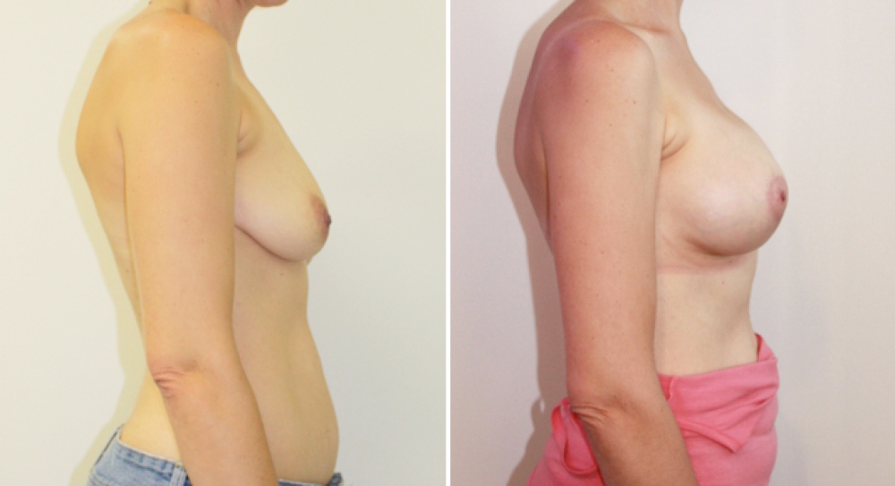 Late 30s, 5 children, vertical short scar breast lift with 410g high teardrop implant (right side) and 360g (left side) to correct droop and discrepancy.