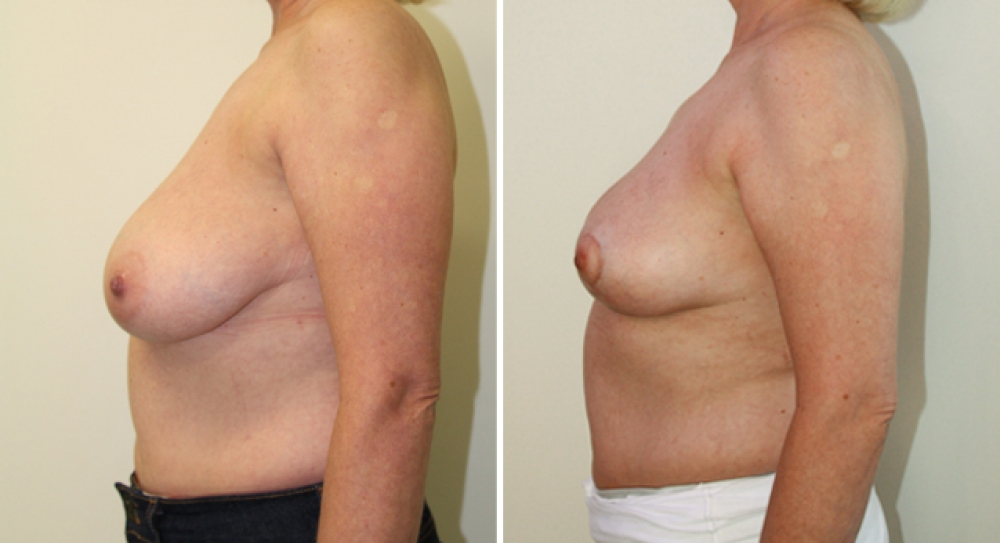 Early 50s, 2 children, vertical short scar reduction/lift with nipple repositioning, approx 200g of breast tissue removed from each side.