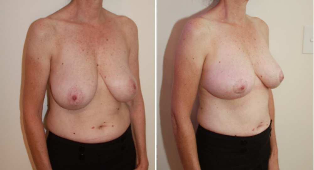 50 yo, 1 child, bilateral breast reduction and lift performed with approx 125g of breast tissue removed from each side.