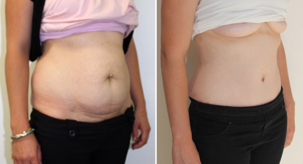 30 year old, 3 children, full abdominoplasty performed to remove excess fat and skin and provide better abdominal definition.