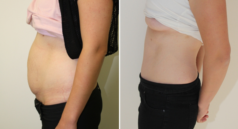 30 year old, 3 children, full abdominoplasty performed to remove excess fat and skin and provide better abdominal definition.