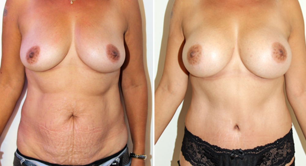 Mid 40's, 4 children, breast augmentation, using 395g teardrop implants, combined with full tummy tuck procedure to remove excess skin and stretch marks and to restore contour and cosmetic appearance.