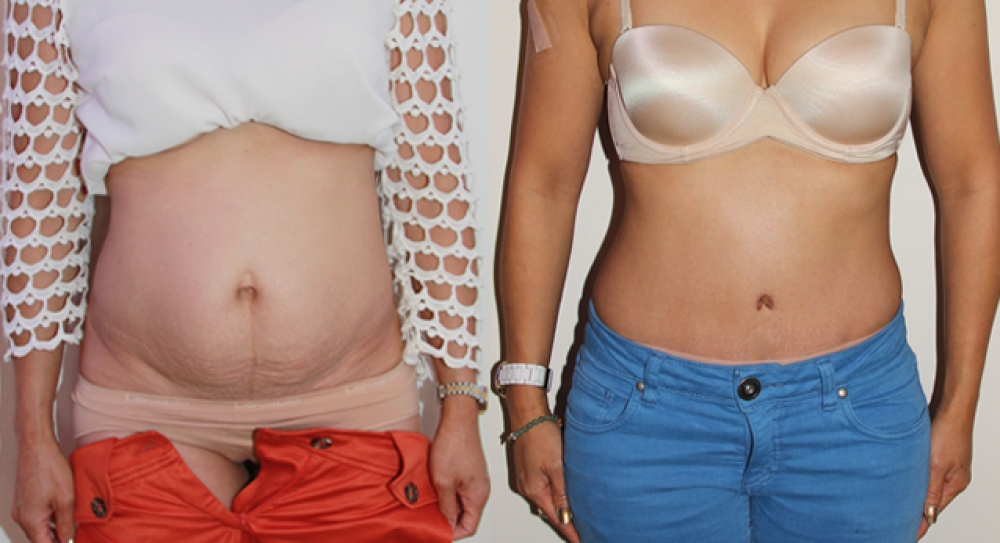 Late 30s, 3 children, full tummy tuck procedure performed to remove excess fat, tighten muscles and restore pre baby body.
