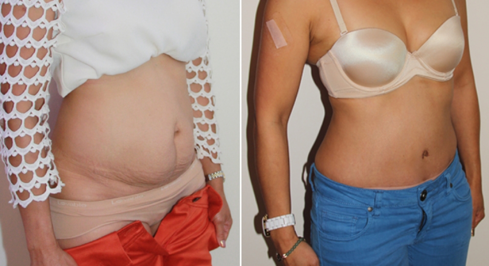 Late 30s, 3 children, full tummy tuck procedure performed to remove excess fat, tighten muscles and restore pre baby body.