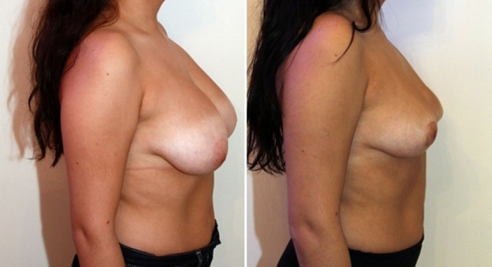 Early 20s, no children, bilateral breast lift and nipple reshaping with 180g of breast tissue removed from the left breast and 176g removed from the right breast.