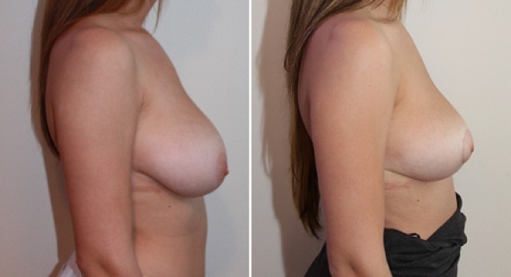 Early 20s, no children, vertical breast reduction and lift performed with 242g of breast tissue removed from left breast and 173g from right breast.