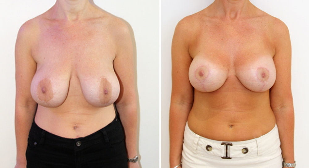 40 yo, 1 child, revision breast augmentation, reshaping and implant change. This lady had her breasts distorted over time by her implants of many years. New 360g textured round implants have been combined with her reshaping/lifting procedure.