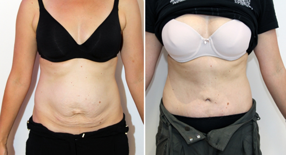 Late 30s, 2 children, full abdominoplasty performed to remove excess skin and improve abdominal definition.