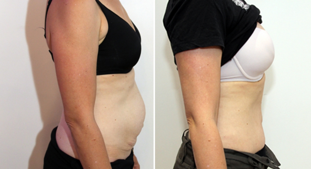 Late 30s, 2 children, full abdominoplasty performed to remove excess skin and improve abdominal definition.