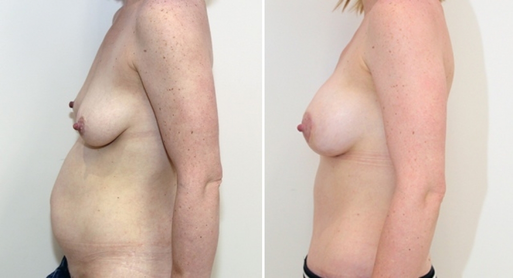 34 yo, 2 children, full abdominoplasty combined with bilateral breast augmentation mastopexy (implants+lift) using 275g textured, round implants.