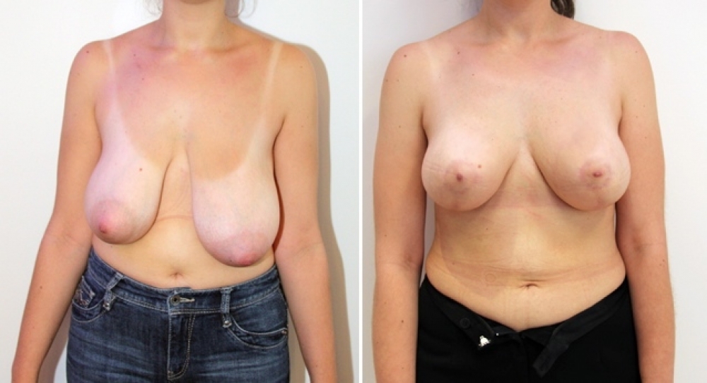 29 yo, no children, bilateral breast lift/reduction performed with approx 310g of breast tissue removed from left and 275g removed from right breast to correct symmetry and shape of breast.
