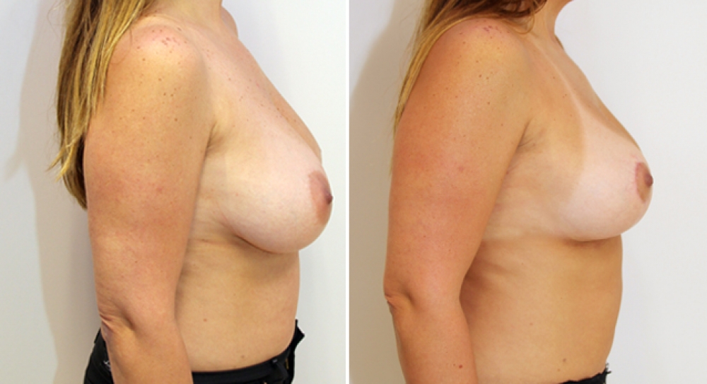 40 yo, 1 child, bilateral breast lift/reduction performed with 82g of breast tissue removed from right and 38g removed from left breast to improve breast position and shape.