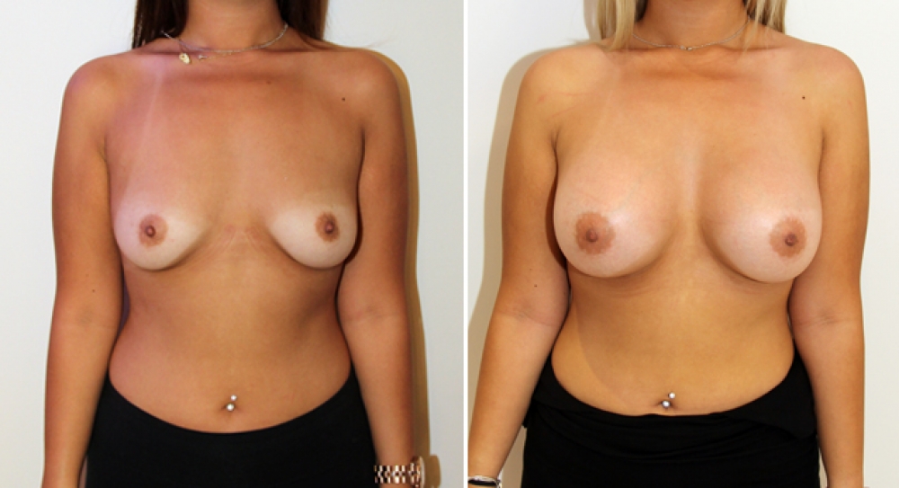 20 yo, no children, bilateral breast augmentation performed using 390g, textured anatomical (teardrop) implants with subfascial placement.