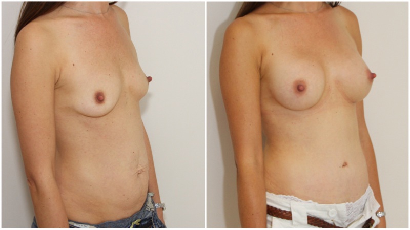 215g subfascial breast augmentation combined with muscle tightening tummy tuck.