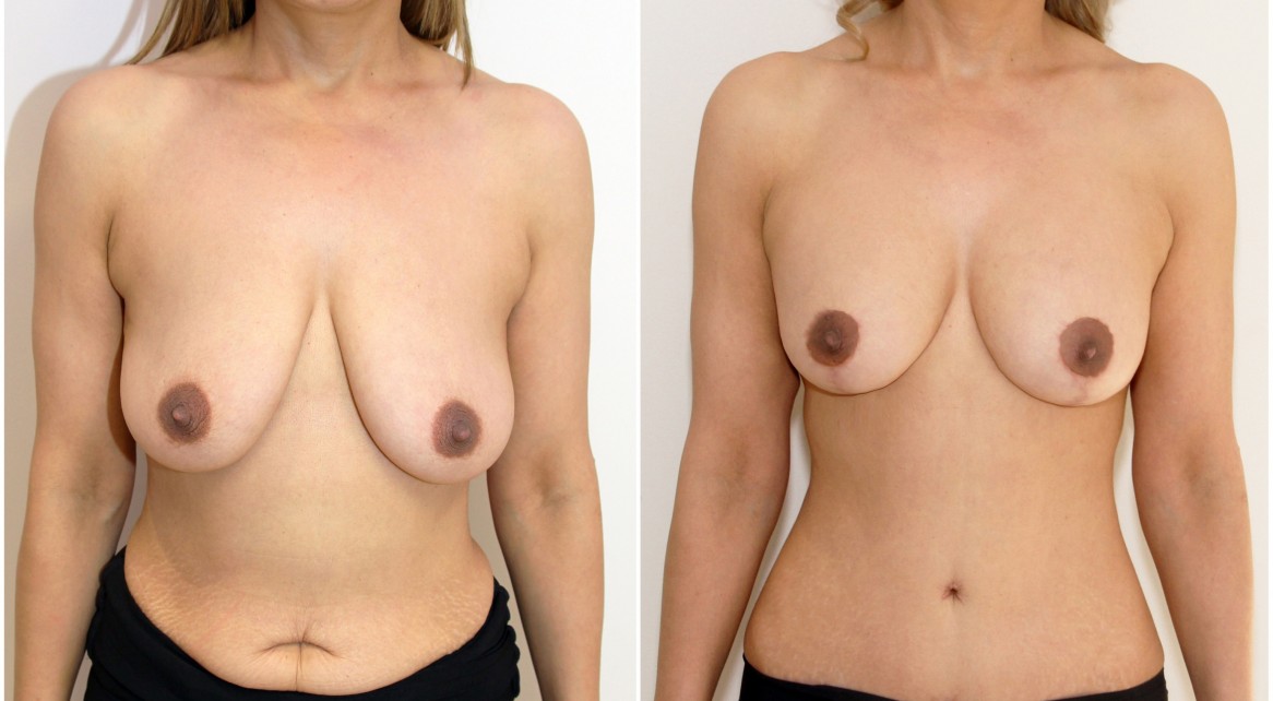 40s, children, waist creation and muscle/skin tightening, belly button repositioning and reshaping with a full tummy tuck. A breast lift has also been performed.