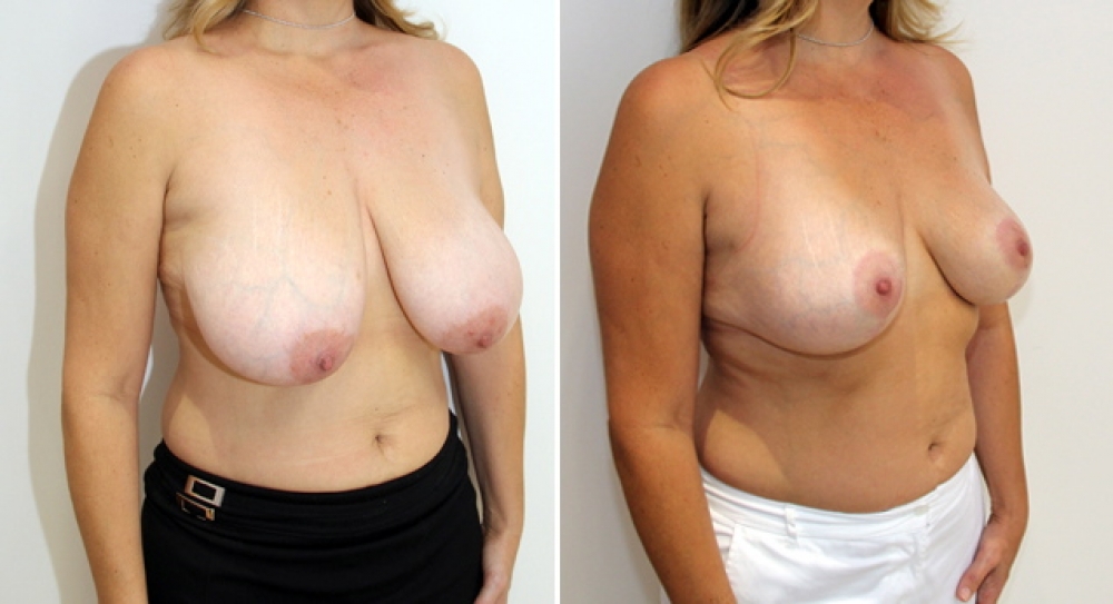 Mid 40's, 3 children, vertical short-scar breast reduction and lift with nipple repositioning and reshaping. Approximately 345g of tissue removed from left and 375g from right breast.