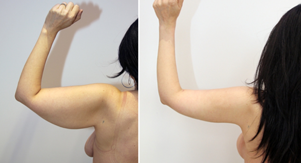 42 yo, bilateral brachioplasty performed to restore a slim and youthful appearance to arms.