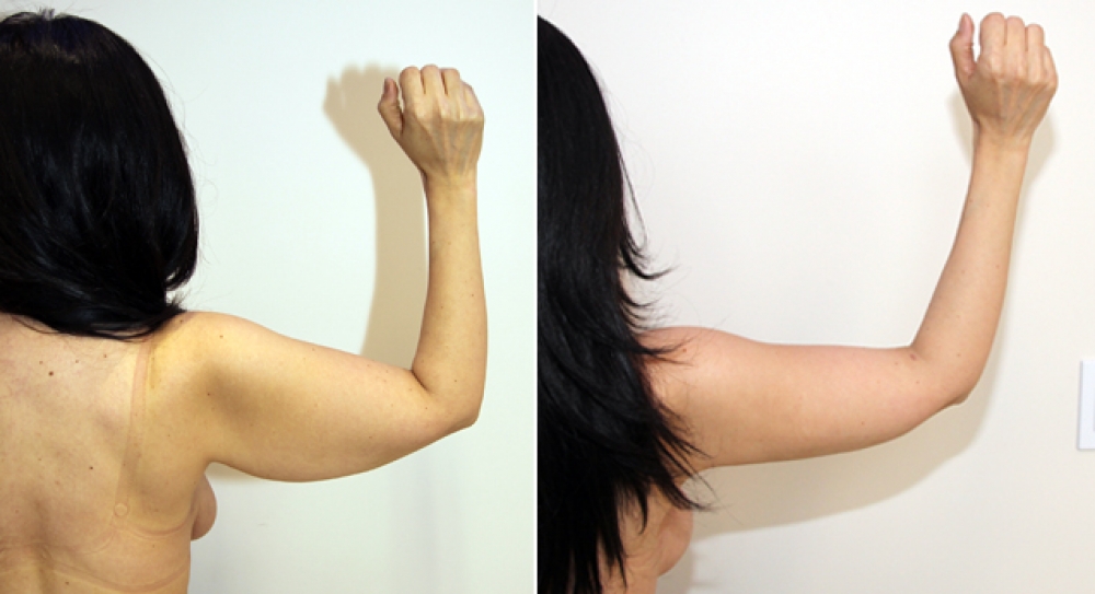 42 yo, bilateral brachioplasty performed to restore a slim and youthful appearance to arms.