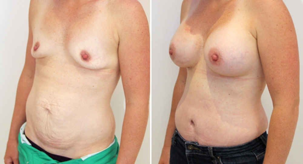 31yo, 3 children, full tummy tuck combined with breast augmentation performed using 440g anatomical (teardrop) implants with dual plane 3 placement.