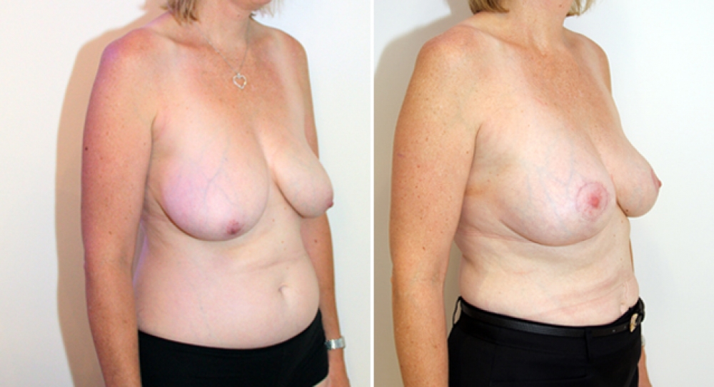 40 yo,1 child, bilateral vertical short-scar breast reduction and lift with nipple repositioning. Approx 63g of tissue removed from left and 92g from right breast.