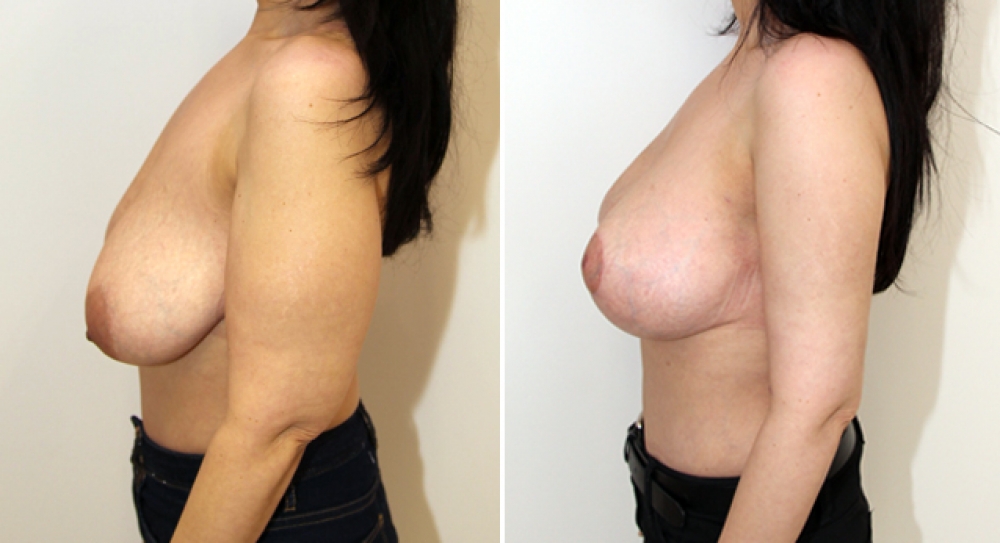 42 yo, bilateral brachioplasty performed to restore a slim and youthful appearance to arms. Note patient has also had a breast lift.