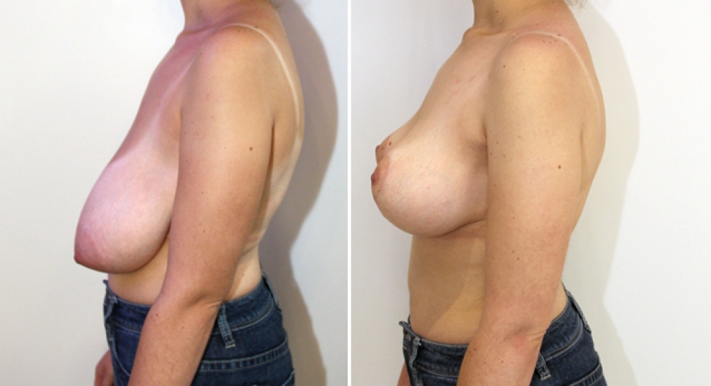 29 yo, no children, bilateral breast lift/reduction performed with approx 310g of breast tissue removed from left and 275g removed from right breast to correct symmetry and shape of breast.
