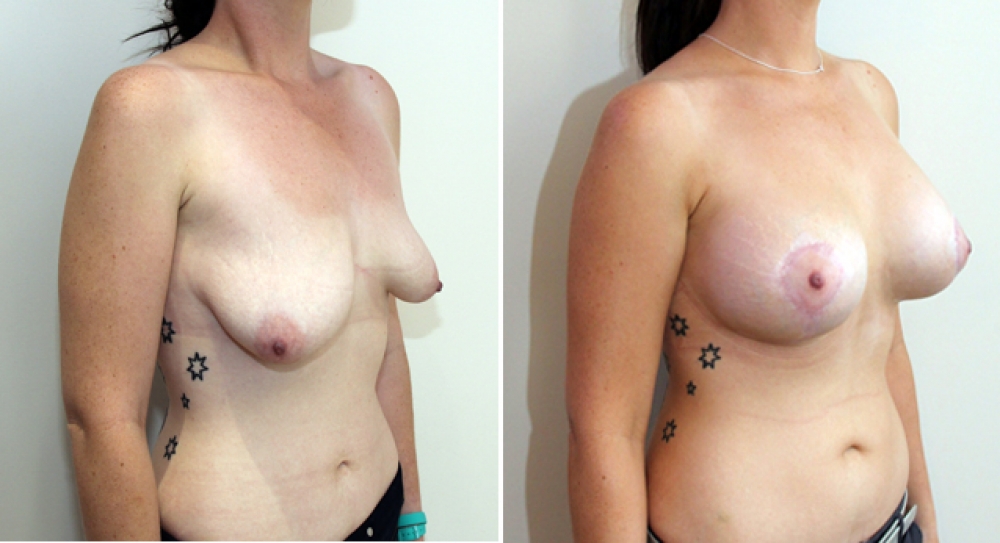 20s, asymmetric tuberous breasts corrected and augmented with vertical and periareolar approach.