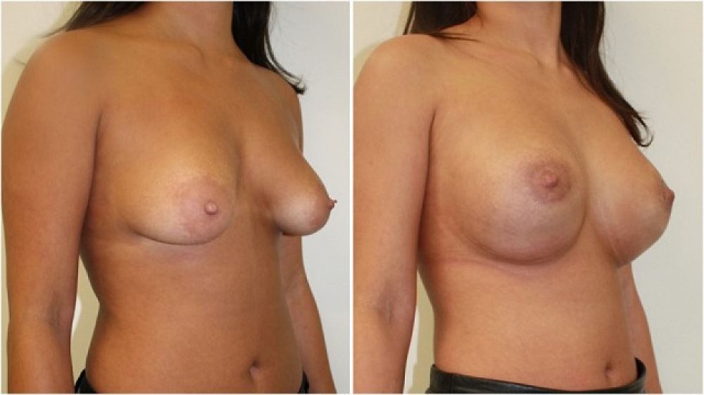20s, moderate tuberous breasts corrected with periareolar approached augmentation (290 g anatomic implants) and parenchymal scoring.
