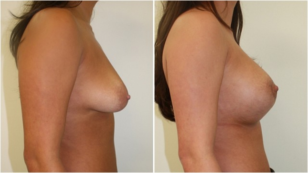 20s, moderate tuberous breasts corrected with periareolar approached augmentation (290 g anatomic implants) and parenchymal scoring.